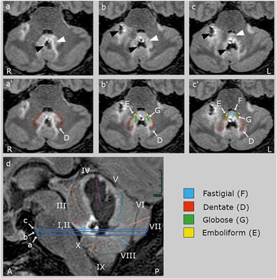 Bilateral lesion of the cerebellar fastigial nucleus: Effects on smooth pursuit acceleration and non-reflexive visually-guided saccades